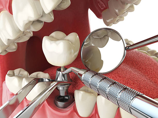 Best Emergency Wisdom Teeth Removal in Friendswood, TX